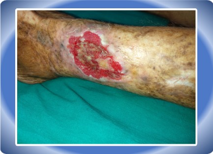 VENOUS ULCER
